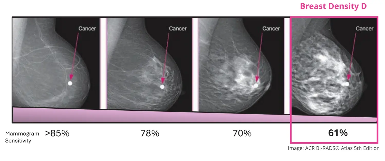 Mammogram images illustrating different levels of breast density, labeled with detected cancer markers. The sensitivity of mammograms decreases with higher breast density, showing values of over 85%, 78%, 70%, and 61%. The images are sourced from the ACR BI-RADS® Atlas 5th Edition.